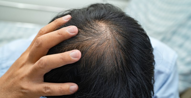 parche con microagujas para la alopecia areata